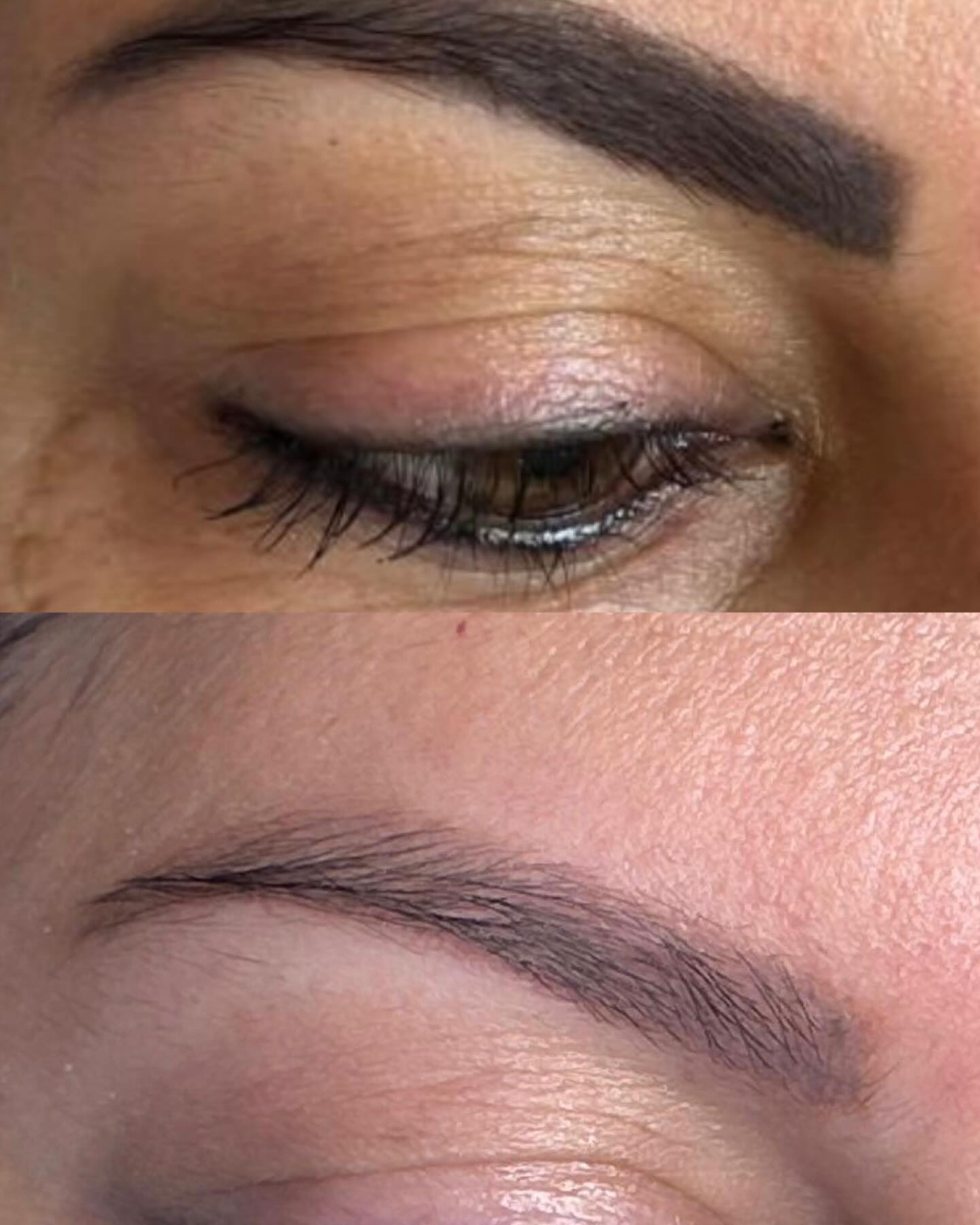Antes e depois de remoção de micropigmentação de sobrancelha