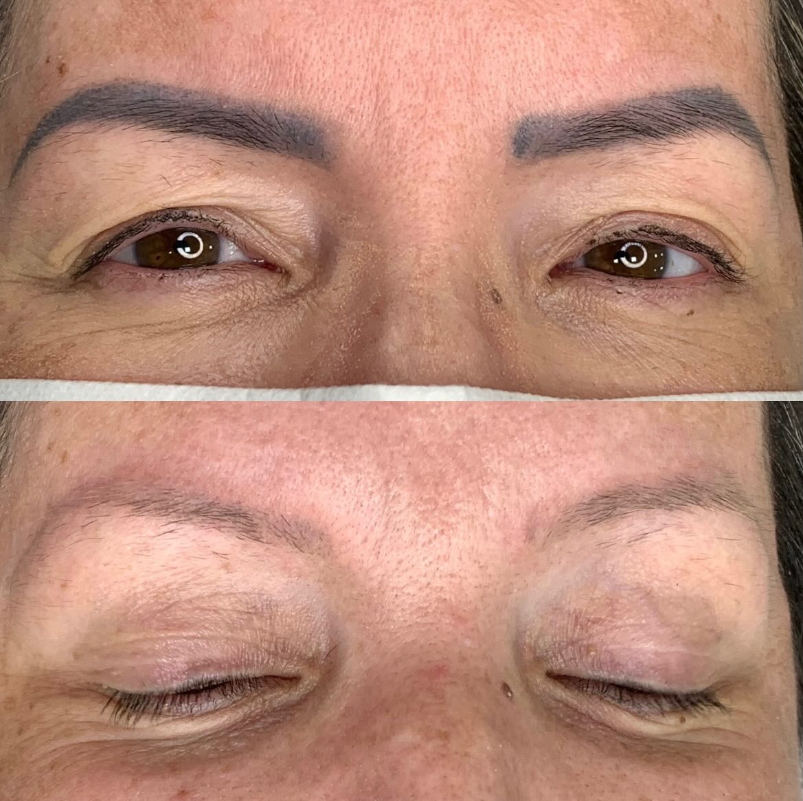 Antes e depois de remoção de micropigmentação das sobrancelhas