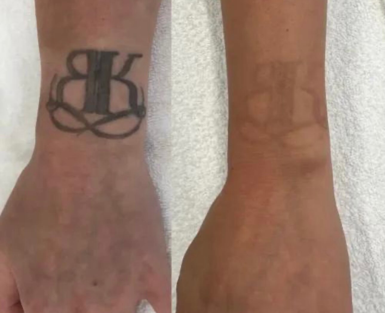 Antes e depois de remoção de tatuagem no pulso
