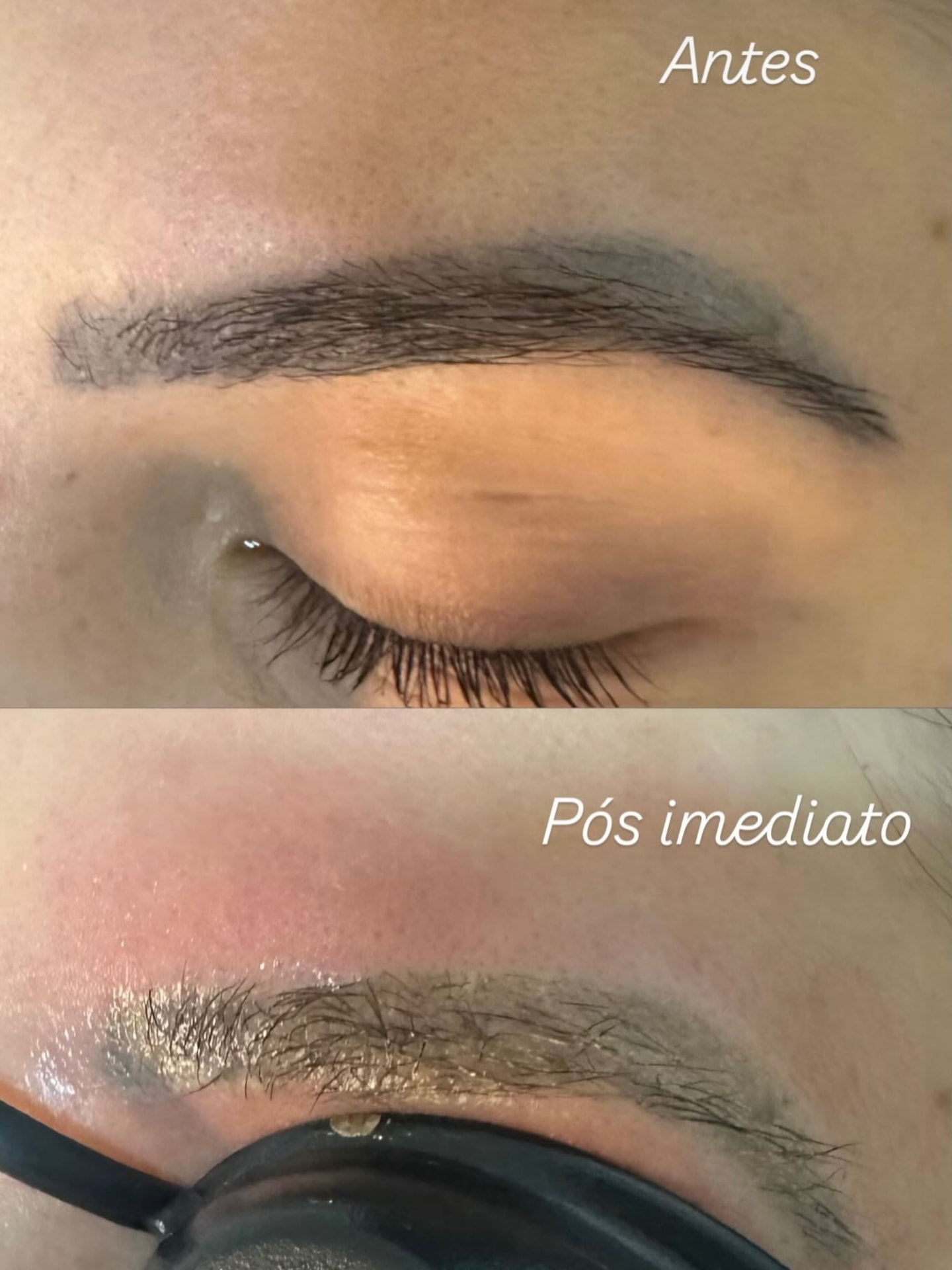 Antes e pós imediato de remoção de micropigmentação de sobrancelha