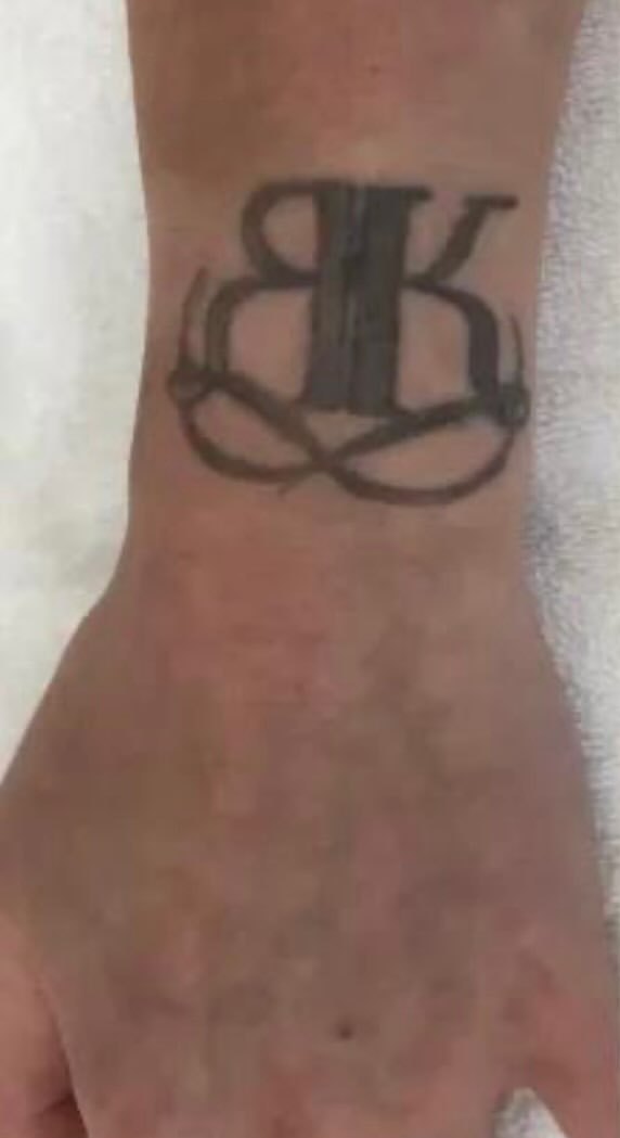 Remoção de tatuagem no pulso — antes