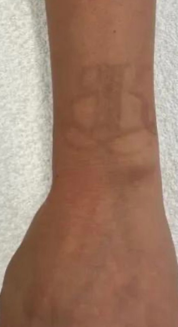 Remoção de tatuagem no pulso — depois