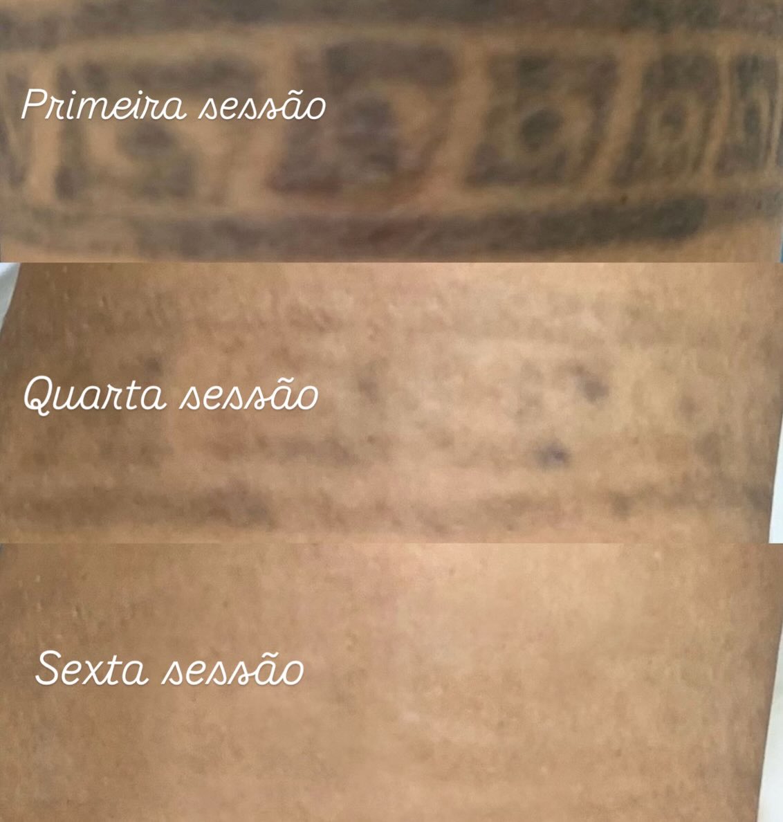 Evolução de uma tatuagem da primeira à sexta sessão de remoção