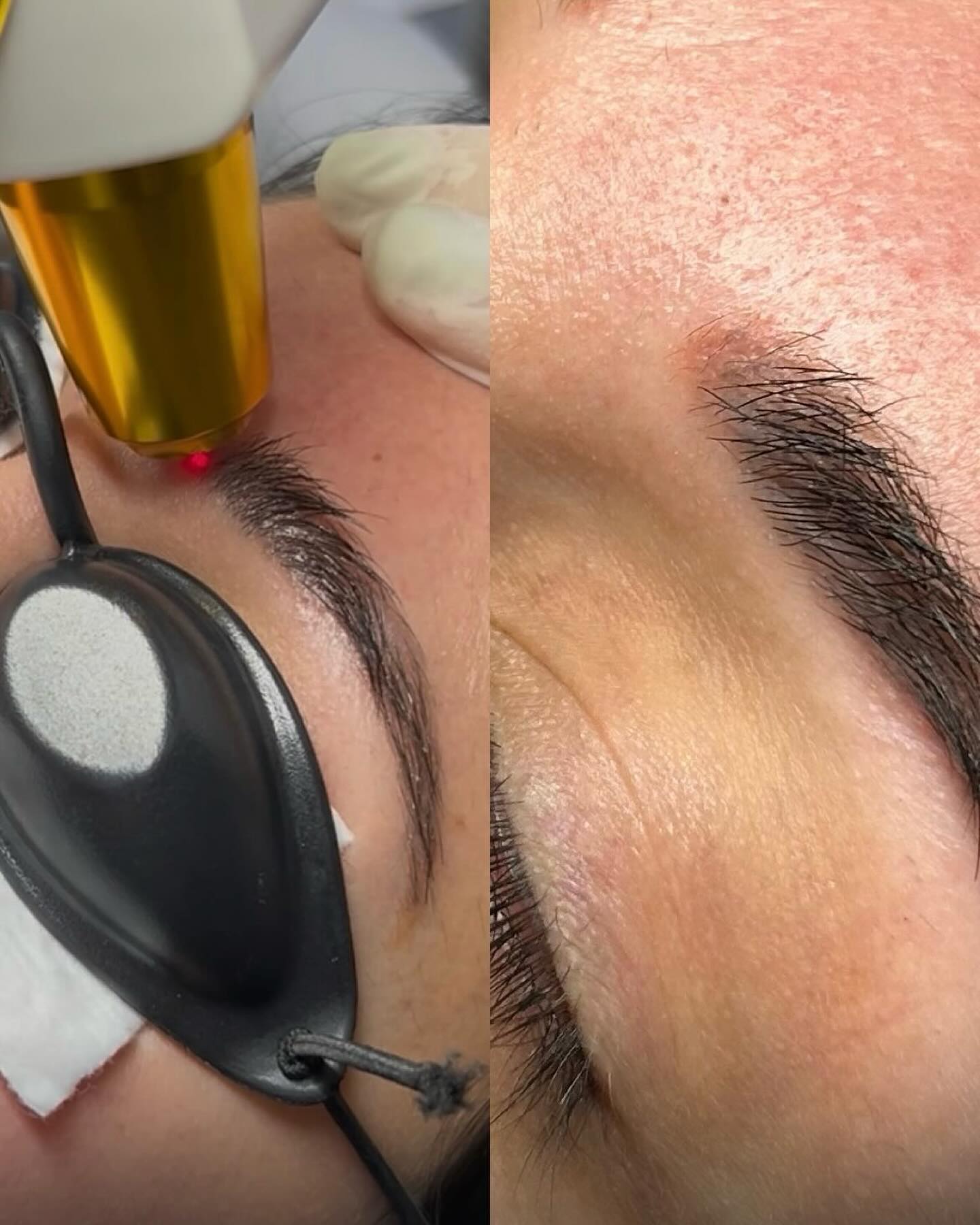 Sessão de remoção a laser em micropigmentação de sobrancelha