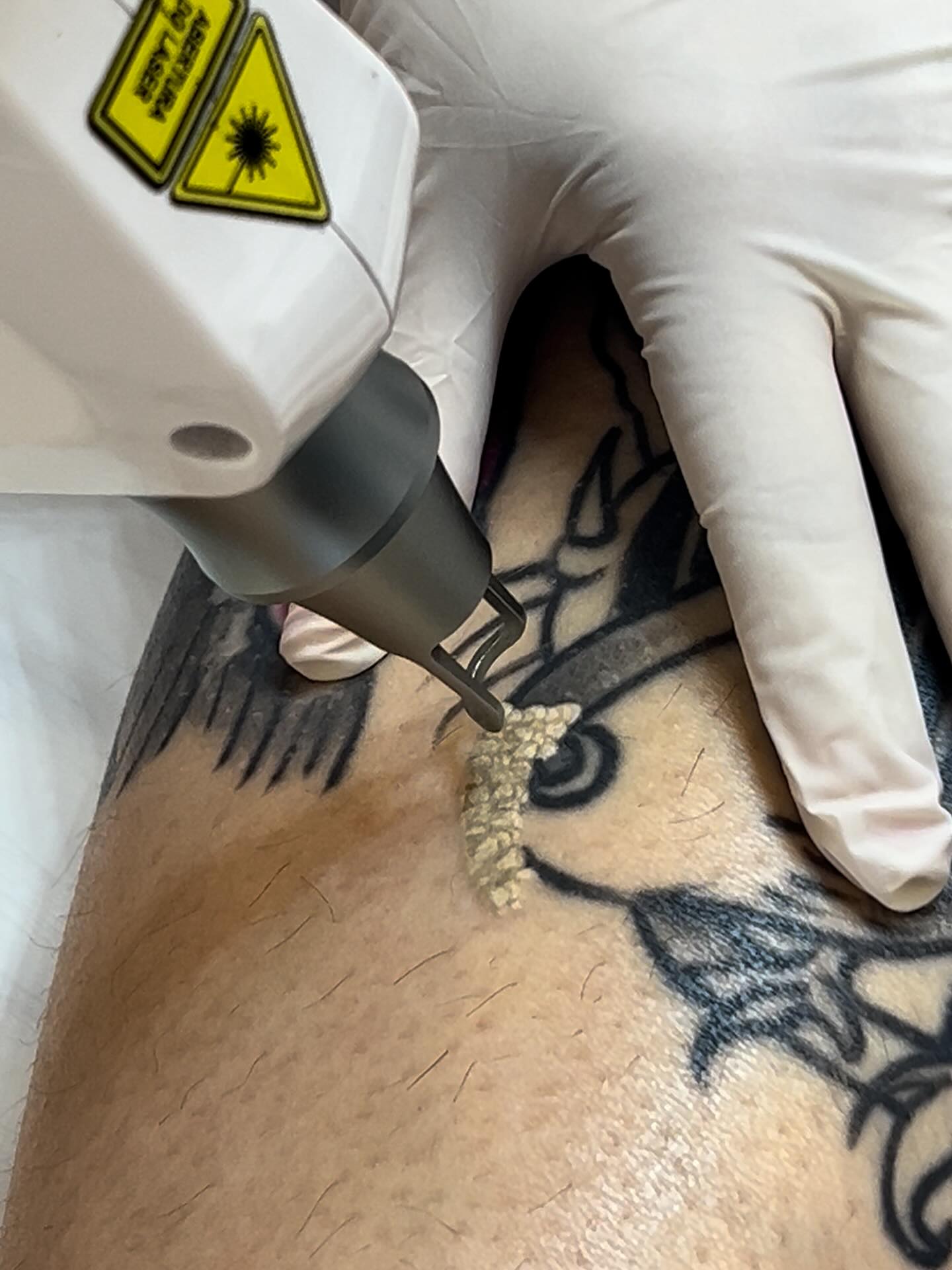 Laser em ação sobre uma tatuagem, com o clareamento imediato do pigmento