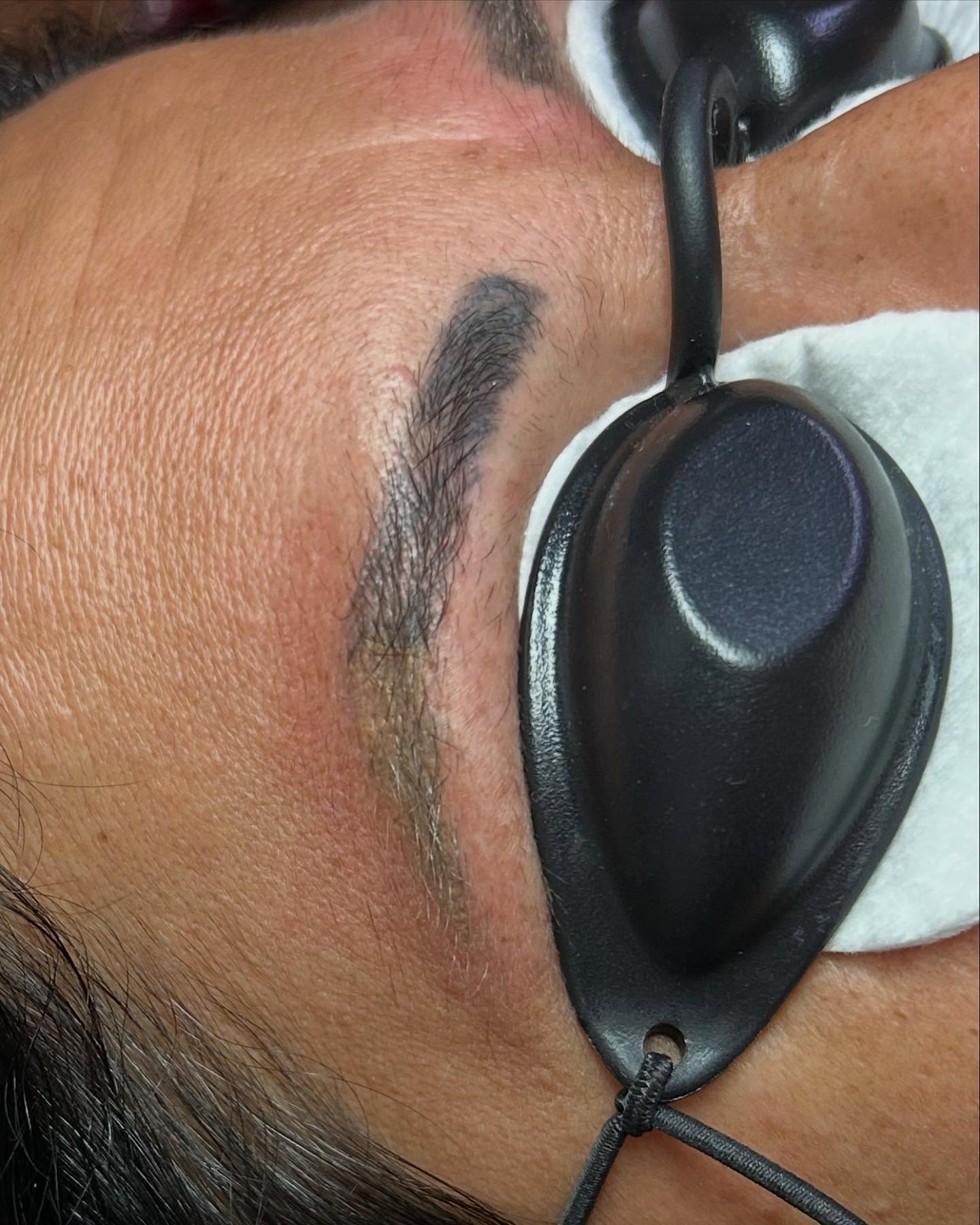 Cliente com proteção ocular durante a sessão de remoção de sobrancelha